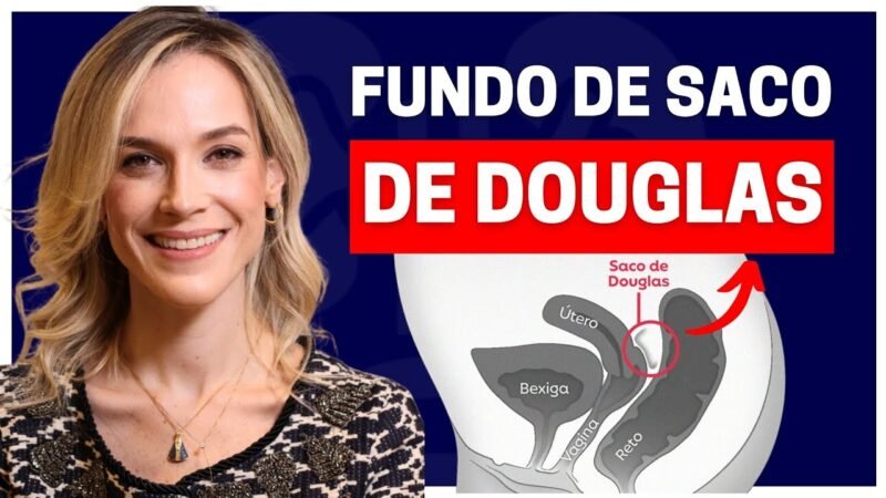 FUNDO DE SACO DE DOUGLAS: TUDO QUE VOCÊ PRECISA SABER!