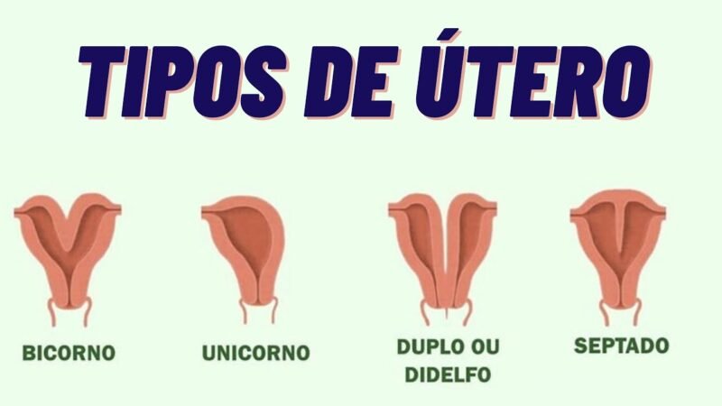 TIPOS DE ÚTERO (Grazy Dutra)